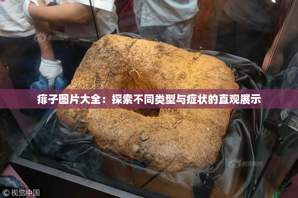 痱子图片大全：探索不同类型与症状的直观展示
